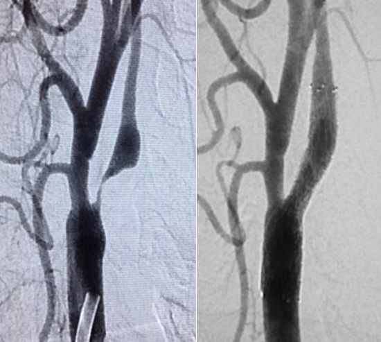 Estenose de carotida, vertebral e intracraniana