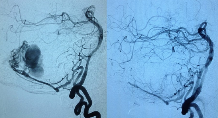 Aneurisma cerebral