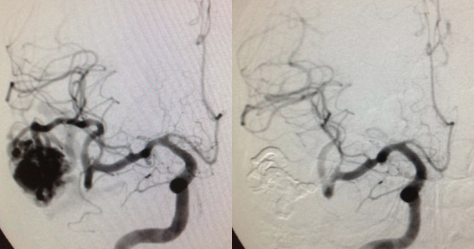 Aneurisma cerebral