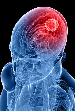 Tumor cerebral