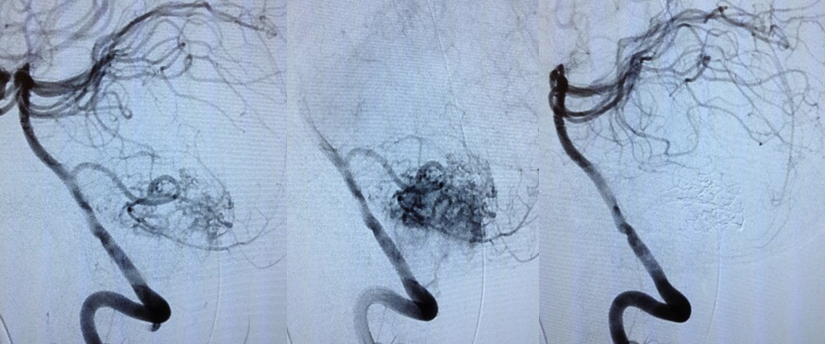 Tumor cerebral